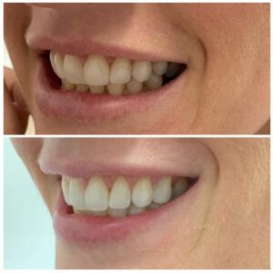 Are you looking for Teeth Whitening in Leigh-on-Sea, Essex?