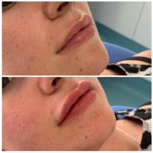 Do you require Lip Fillers in Southend on Sea?